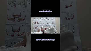 Jaw Reduction 3D Model and Surgical Plan #boardcertifiedplasticsurgeon