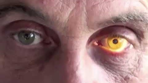 Argyll Robertson pupil - infamously called prostitute