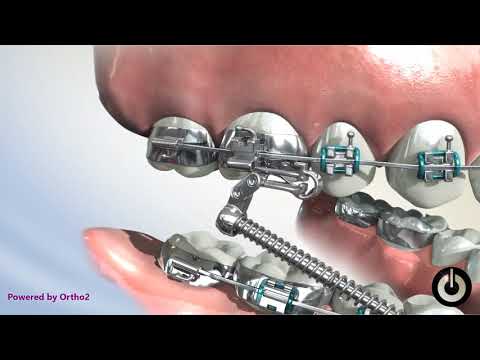 Forsus™ EZ Module