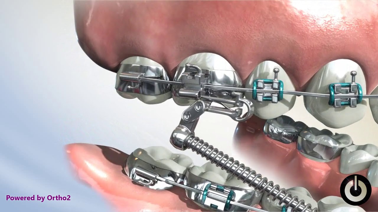 Forsus™ EZ Module | Dental Braces | Temecula Valley, CA