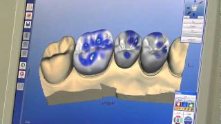 Cerec Houston Cadcam Video - Same Day Porcelain Crowns From The Houston Dentists