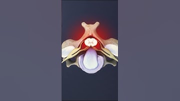 Causes of Spinal Cord Compression