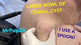 GIANT CYST removed with a spoon!Tricky removal with heart condition and wheelchair but I get it done