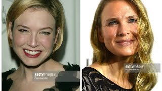 Renée Zellweger Plastic Surgery Before and After Photos