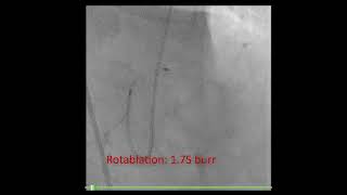 Left main PCI, Calcified aorto-ostial lesion Wealth