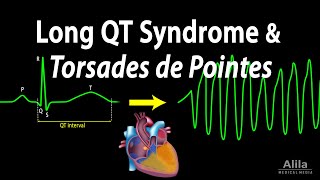 Long QT Syndrome and Torsades de Pointes, Animation