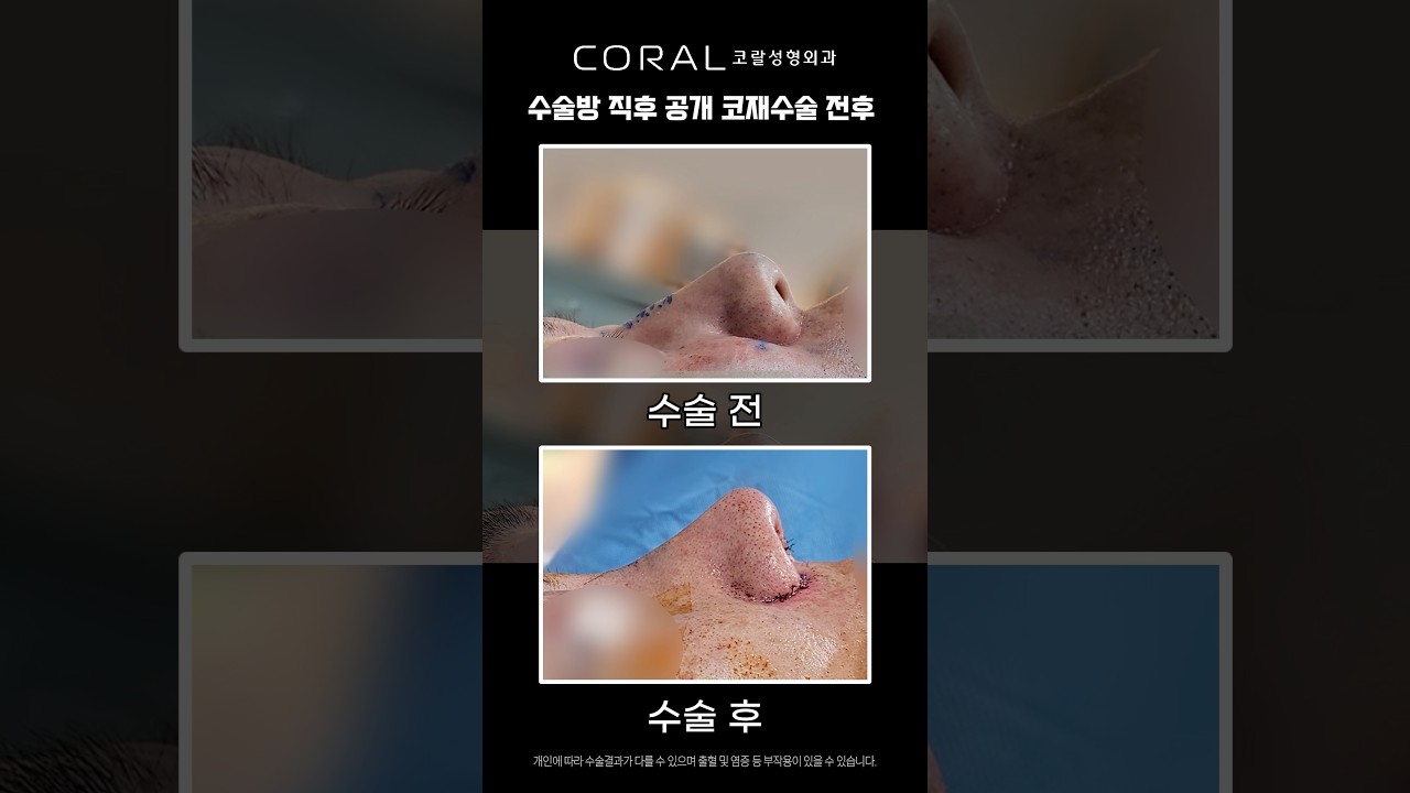 코끝 뭉툭함 싹 잡은 코재수술 레전드 비포애프터 #shorts #코재수술