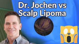 Dermatologist VS Scalp Lipoma!