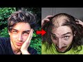 24 Year Old Model Had A Transplant But Stopped Taking Hair Loss Meds And This Is What Happened