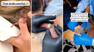 Download lagu Best Satisfying Pimples Popping Cyst Removal Acne Blackheads Compilation Videos #25