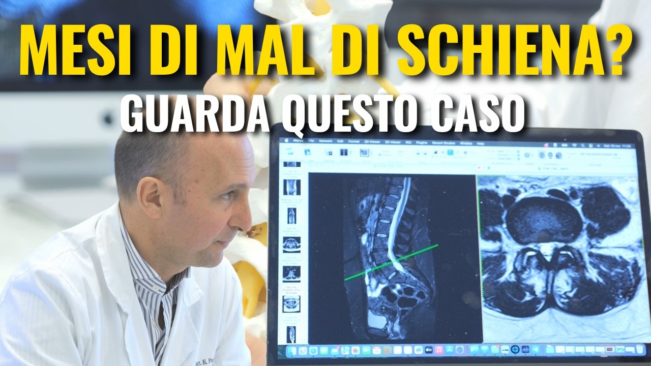 Un anno di dolore lombare: Come diagnosticare e trattare l’instabilità vertebrale L4-L5”