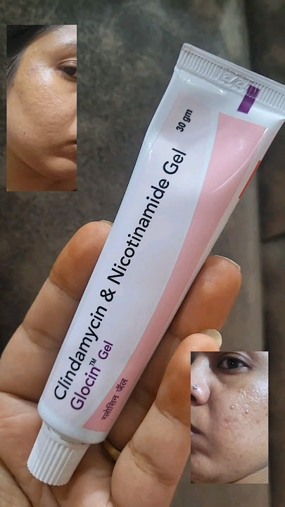 glocin gel review |If you have any doubts of glocin gel check this| clindamycin & nicotinamide gel