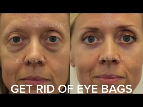 NATURAL RECIPE THAT COMPLETELY ELIMINATES UNDER EYE BAGS & DARK CIRCLE
