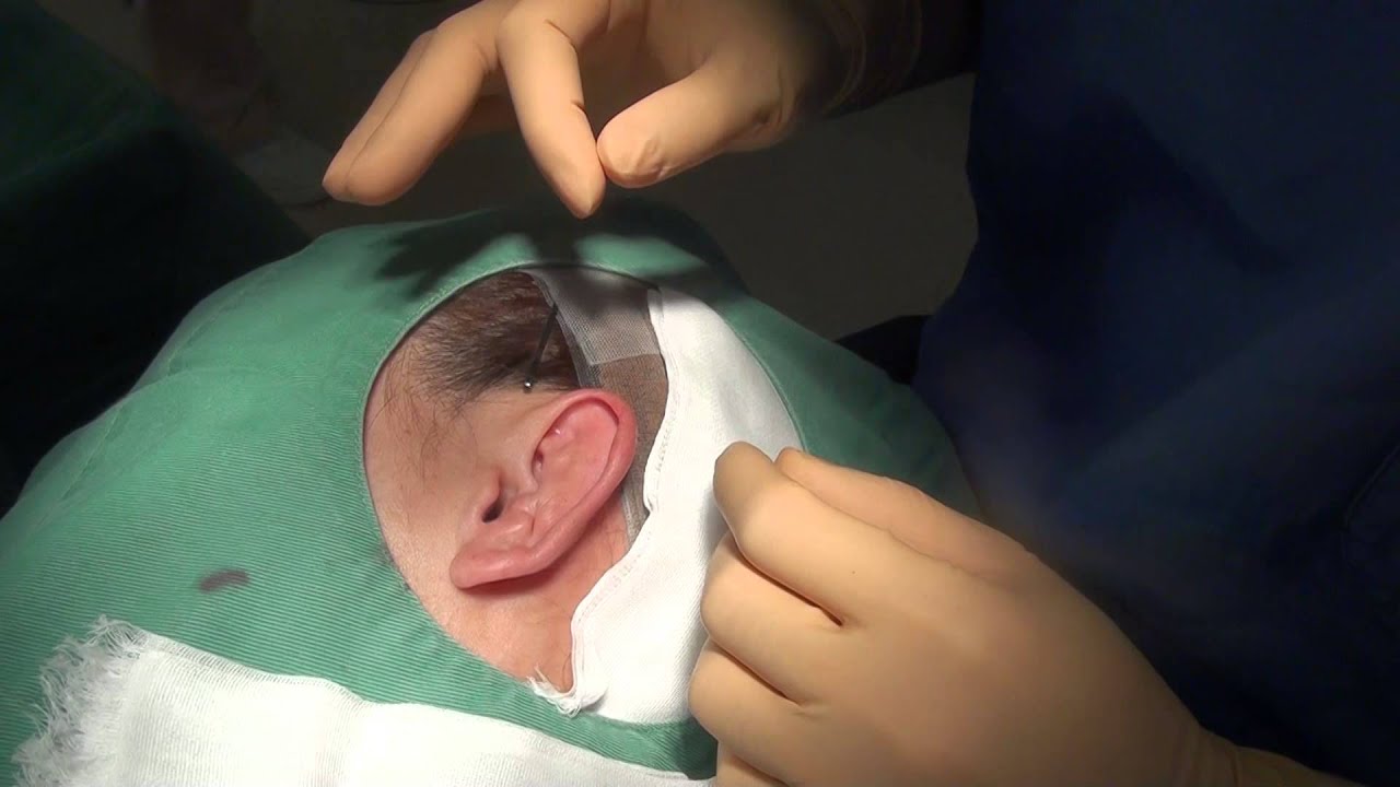 柔道耳 耳 美容外科 高須クリニック