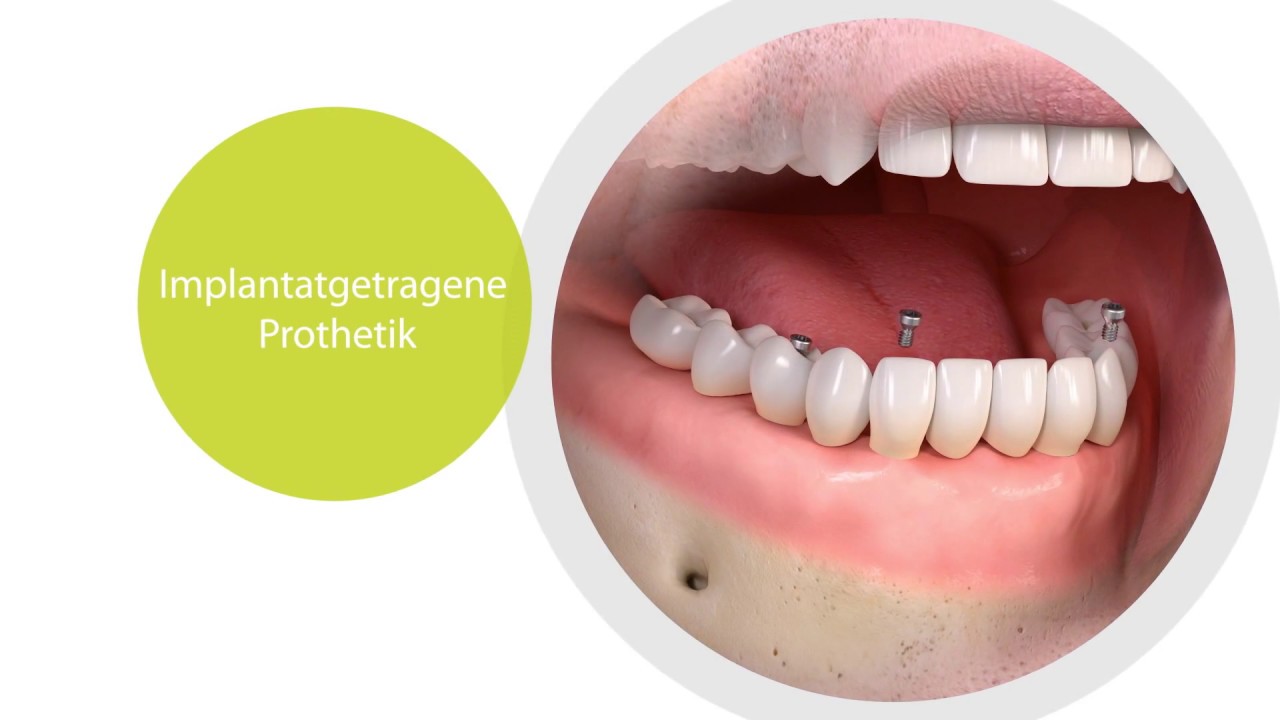 Zahnarzt Schweinfurt Hendrich : Patienten Implantatgetragene Lösungen bei Zahnlosigkeit