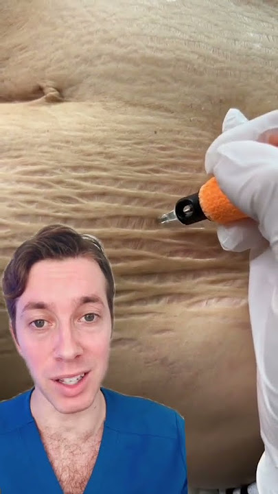 Benarkah Ini Bisa Menghilangkan Stretch Mark?