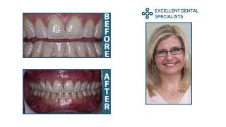 After pinhole surgery it's so nice to be able to smile in public!  Rebecca's Patient Testimonial