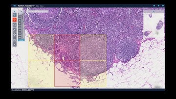 AI-aided Cancer Detection for Lymphatic Metastases Case 2