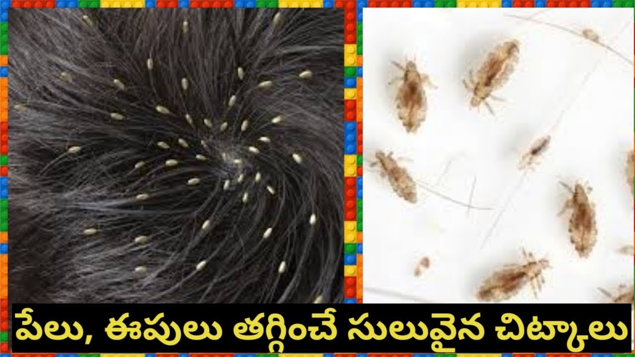 HOW TO GET RID OF HEAD LICE, NITS IN TELUGU|HOW TO REMOVE LICE FROM HAIR  |HOME REMEDY TO REMOVE LICE - YouTube
