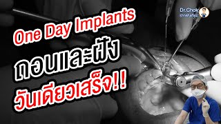 ฟันหน้าผุ ถอนแล้วฝังรากฟันเทียม ในวันเดียวได้ไหม ? | คลายปัญหารากฟันเทียมกับหมอโชค