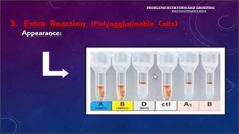 ABO discrepancy and transfusion practice part two By Dr. Mohamed Samir