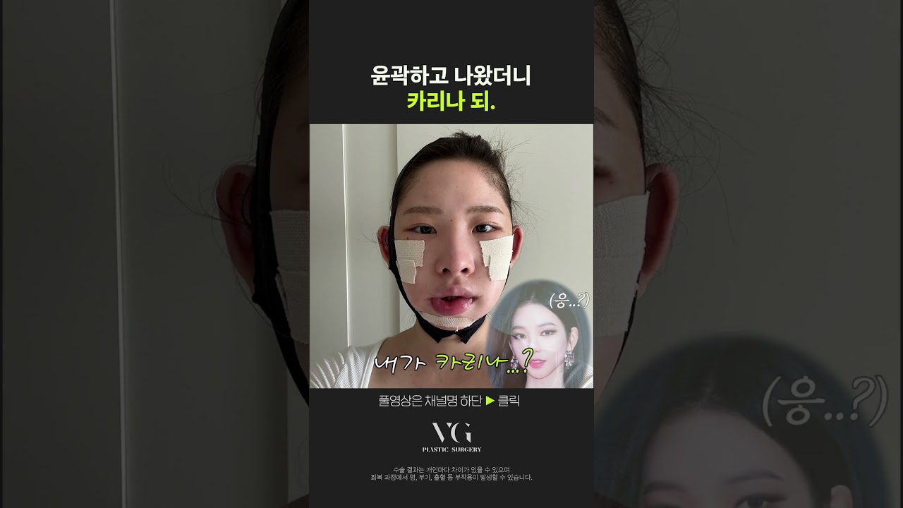 [貝瑞古整形外科診所] 打造卡琳娜的臉型.ai