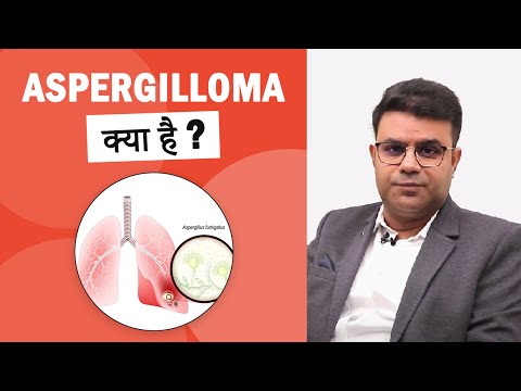 छाती की जटिल बीमारी Aspergilloma या  Fungus Ball | Patient Story