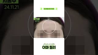 울퉁불퉁한 이마때문에 고민이라면 #이마필러전후