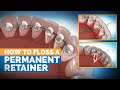 How to Floss a Permanent Retainer | Premier Orthodontics
