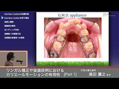 The Effectiveness of Carriere Motion in Lingual Orthodontics and