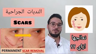 احدث طرق علاج الندبات ازاي ممكن تختفي مش زي زمان /هل صح تتشال جراحه تاني ؟