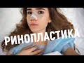 РИНОПЛАСТИКА | ДО И ПОСЛЕ