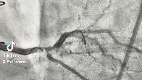 Tips & Tricks to wire a complex side branch ostial lesion!