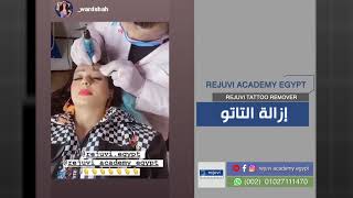 ازالة تاتو الجواجب - rejuvi academy Egypt