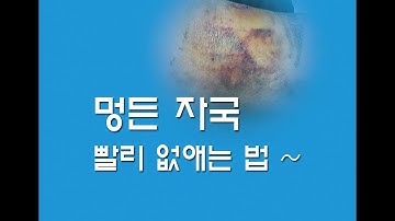 멍든 자국 어떻게 뺄까요? 멍 빨리 빼기