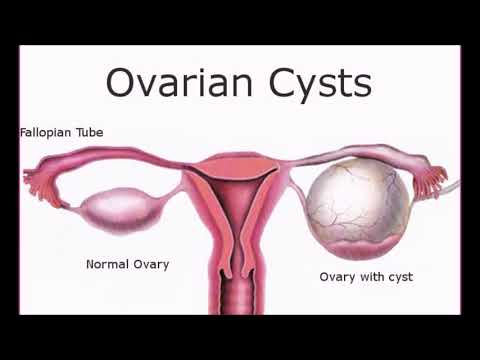 the-real-cause-of-ovarian-csysts
