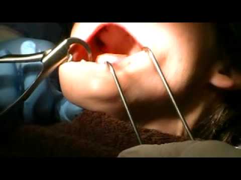 Physics Forceps Full Mouth Extractions + OCO Biomedical Implants (Full)