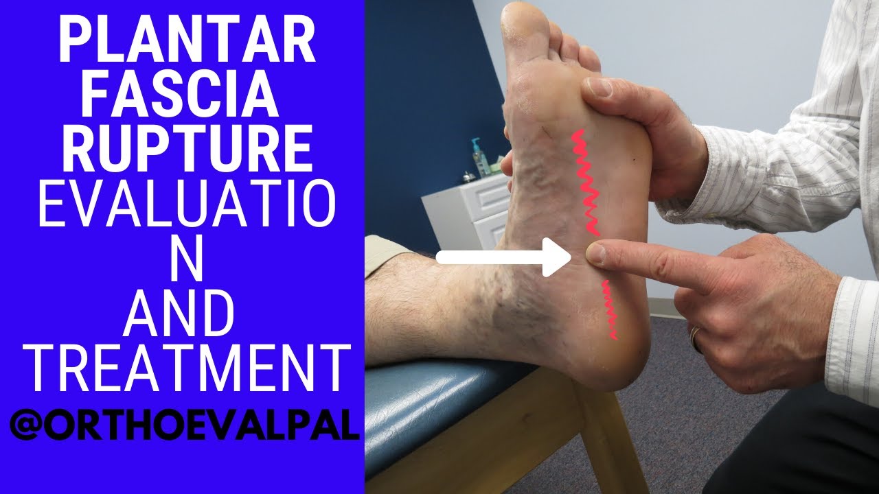 How to treat a Plantar Fascia tear