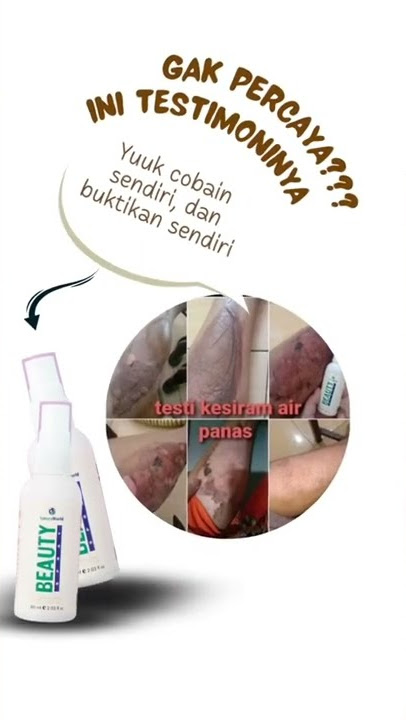 Testimoni natura beauty spray untuk sakit kulit herpes dompo