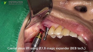 Immediate implant surgery with crestal sinus elevation. Easy periotome, MagiCore