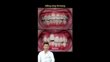 Tình Trạng Răng Lệch Lạc | Bác Sĩ Yên