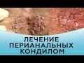 Лечение перианальных кондилом