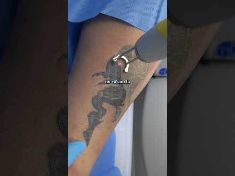 #EliminaciónDeTatuajes#LaserTattooRemoval#DiscoveryPico#QuantaSystem#TecnologíaLáser