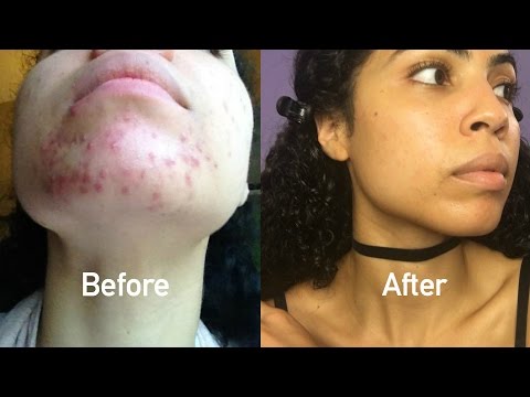 How I Naturally Cured My Cystic Acne