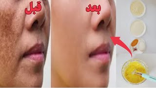 طريقة طبيعية لعلاج الكلف وجميع تصبغات /وصفة لإزالة الكلف والبقع من الوجه