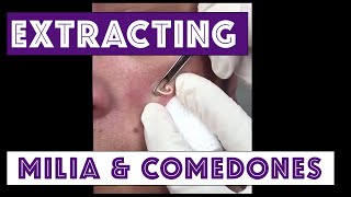 Extracting milia and comedones. Acne.  For medical education- NSFE.