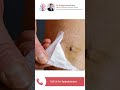 Varicose veins treatment #varicoseveins #bestdoctor #apollo #surgical #hyderabad #shorts #viral #yt