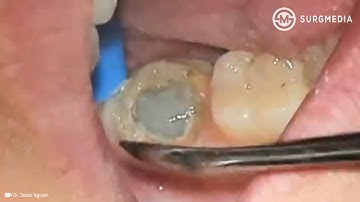 Failed Root Canal Treatment on a Wisdom Tooth: Extraction