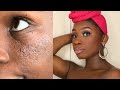 HOW TO MAKE ACNE SCARS DISAPPEAR ! DETAILED TUTORIAL