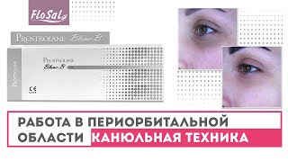 Работа в периорбитальной области. Канюльная техника. Prostrolane Natural-B. РАЗМЕТКА.ФОТО ДО И ПОСЛЕ